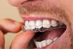 bite per bruxismo