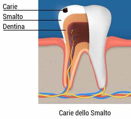 carie dello smalto