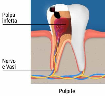 pulpite