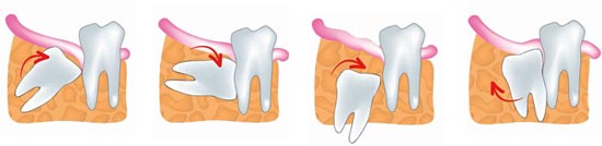 denti del giudizio non erotti