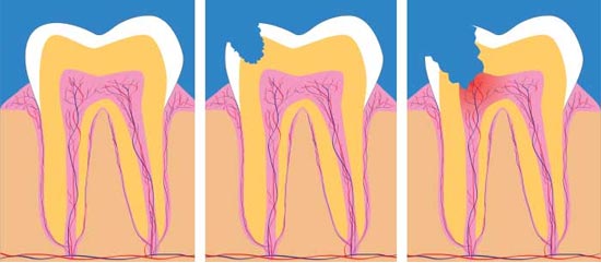 endodonzia