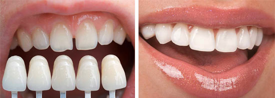 faccette dentali in porcellana