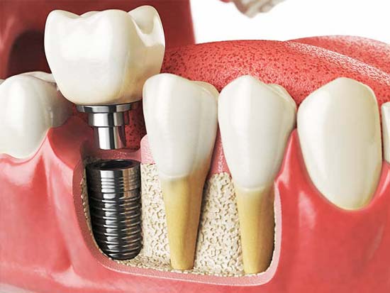 implantologia dentale