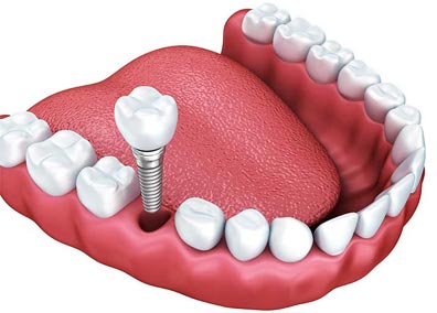 implantologia dentale