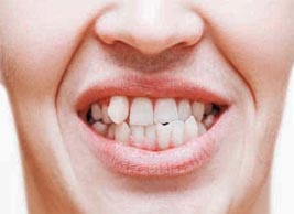 affollamento dentale