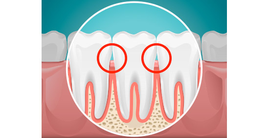 Pulire con lo scovolino lo spazio tra i denti
