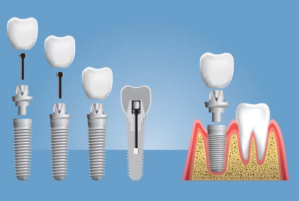 impianti dentali