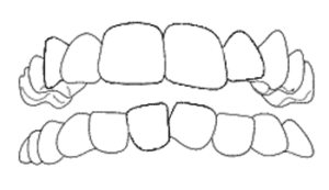 affollamento dentale