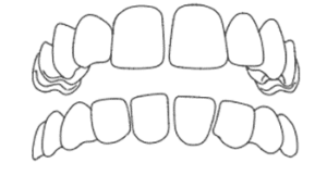 spazi tra i denti
